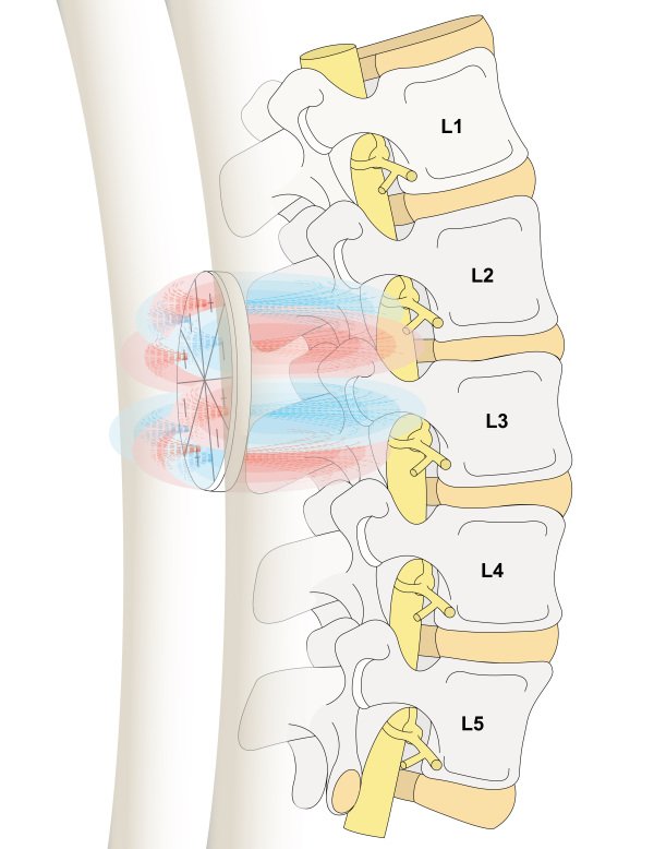 OF50-3 for Back Pain Treatment using Magnetic Therapy