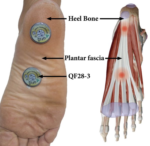 Q Magnets Application For Plantar Fasciitis. Click for larger image.