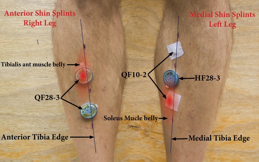 Shin soreness threatens competing in marathon – no worries with Q Magnets.