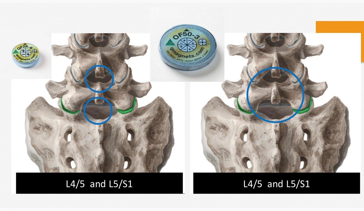 spinal disc treatment with magnetic therapy